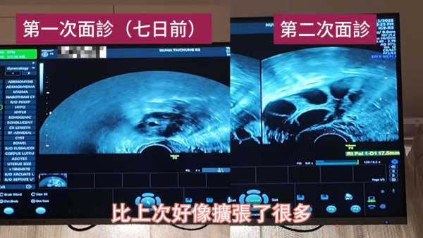 38歲糖妹單身多年忍痛雪卵 揭身體質素極驚人！閨蜜王敏奕幫手打針