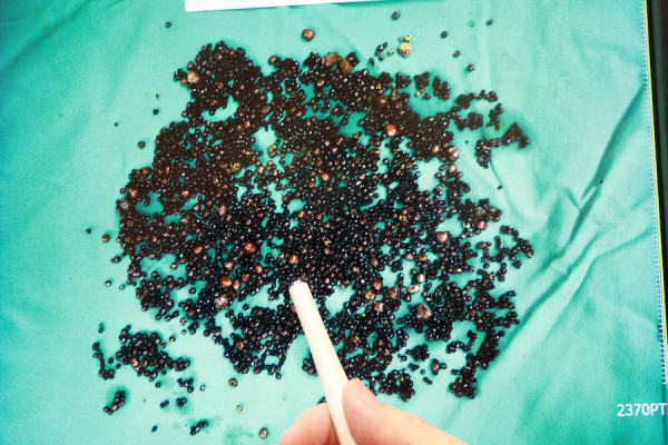 43歲男愛吃2物養出5000顆膽結石！膽囊比正常大1倍險炸裂／曾以為胃病險誤診(附症狀自測)