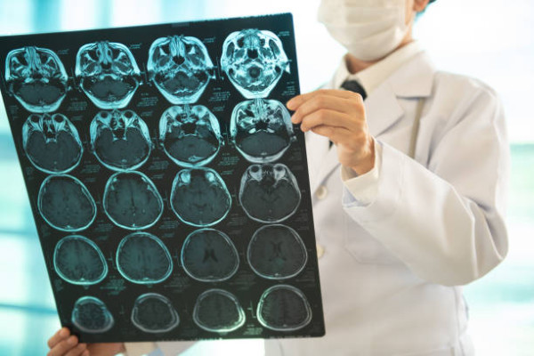 67歲婦突視力模糊以為老花竟是二度中風！無眼歪嘴斜非典型中風／ 醫生:錯過黃金期恐癱瘓