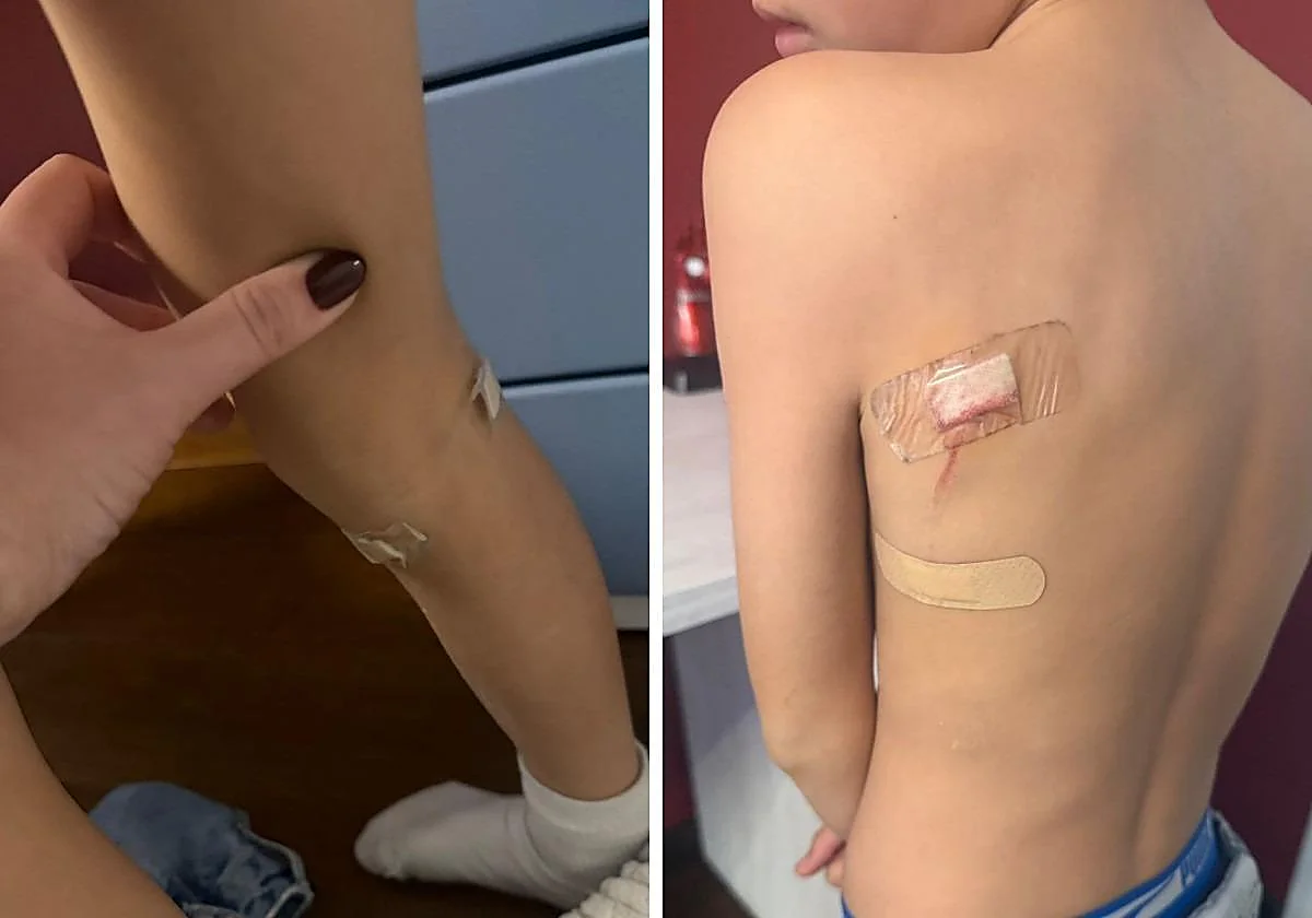 (該名受傷男孩的傷勢)圖片來源:SUR (該名受傷男孩的傷勢)圖片來源:SUR