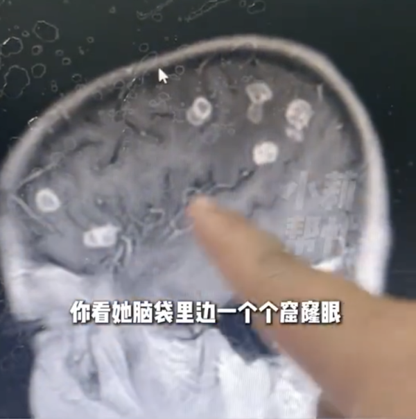 大掃除後發燒17日「腦穿20個洞」少女險變植物人!醫生揭1個物質係致命元兇