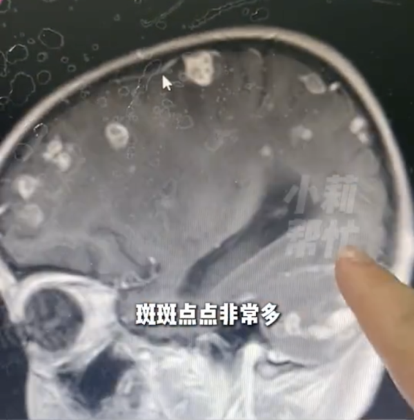 大掃除後發燒17日「腦穿20個洞」少女險變植物人！醫生揭1個物質係致命元兇