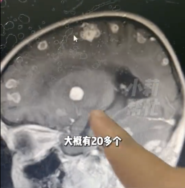 大掃除後發燒17日「腦穿20個洞」少女險變植物人！醫生揭1個物質係致命元兇