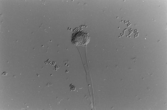 大掃除後發燒17日「腦穿20個洞」少女險變植物人!醫生揭1個物質係致命元兇