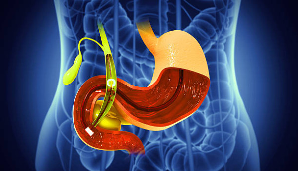 30歲女戒早餐減肥90日激減30磅代價慘重！突劇痛切除膽囊 醫生：1類人風險高5倍