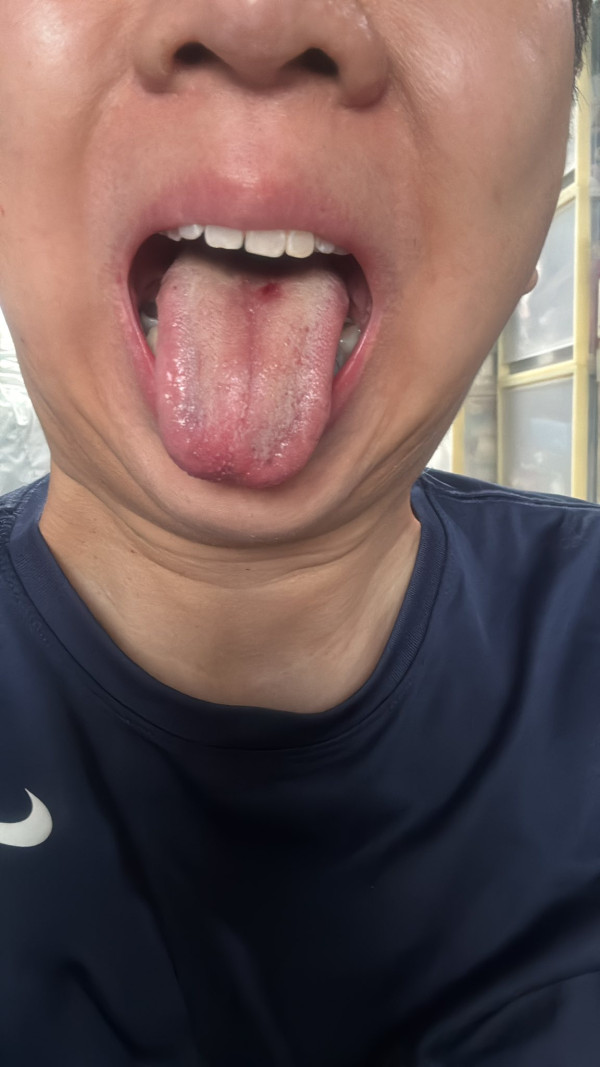 屯門Aeon燒賣藏1.5cm生鏽鐵針  食客舌頭被刺穿爆血報食環／Aeon主動報警調查