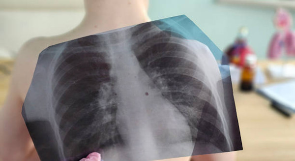 2歲童被親友餵1物右肺塌陷入ICU險死！醫生揭X光照不出／同樣案例3歲童慘成植物人