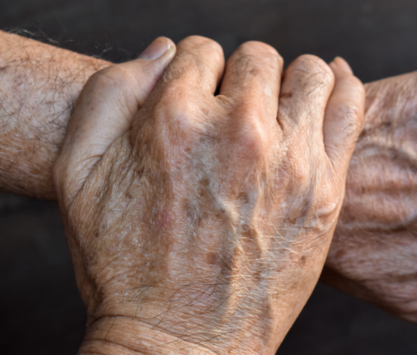 老人斑｜皮膚生斑代表心肺正在老化？美國名醫靠「這兩招」1年消滅老人斑！附10款維他命D食物有效延緩衰老3年