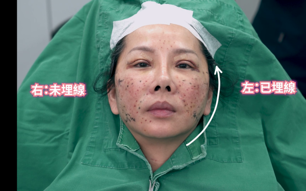 57歲御用師奶驚爆整容失敗！捱痛狂打14針即時回春10年！前後對比極明顯震驚全場 