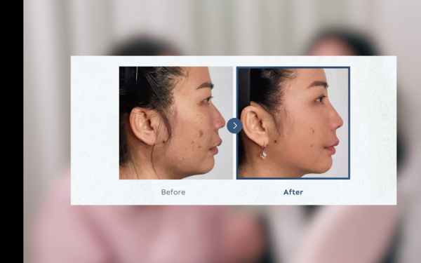 57歲御用師奶驚爆整容失敗！捱痛狂打14針即時回春10年！前後對比極明顯震驚全場 