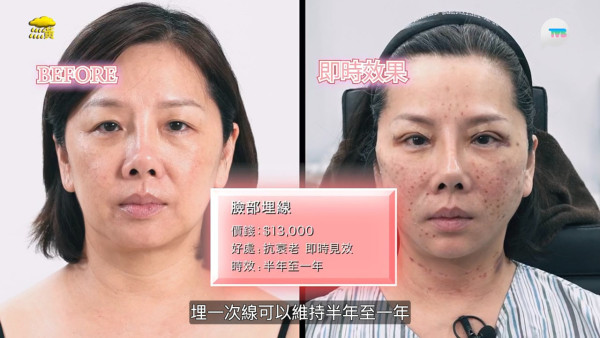 57歲御用師奶驚爆整容失敗！捱痛狂打14針即時回春10年！前後對比極明顯震驚全場 