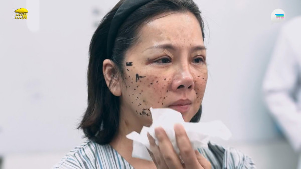57歲御用師奶驚爆整容失敗！捱痛狂打14針即時回春10年！前後對比極明顯震驚全場 