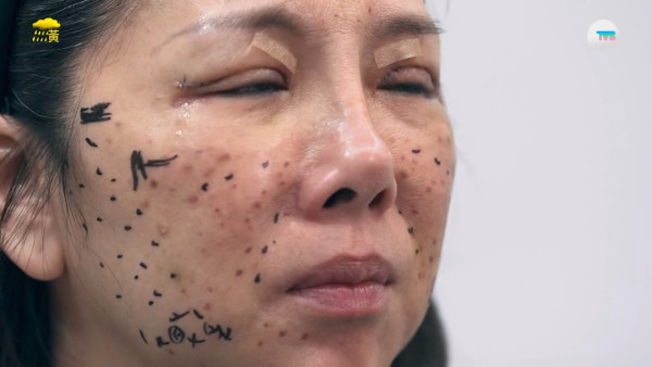 57歲御用師奶驚爆整容失敗！捱痛狂打14針即時回春10年！前後對比極明顯震驚全場 