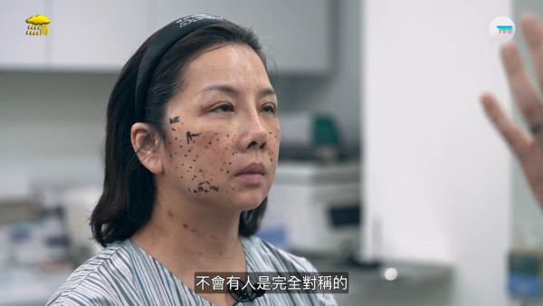 57歲御用師奶驚爆整容失敗！捱痛狂打14針即時回春10年！前後對比極明顯震驚全場 