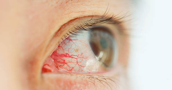 眼中風症狀｜視力模糊恐是視網膜動脈閉塞！醫生揭0痛感致盲 病發心臟病風險高44倍 附4大高危人士/護眼食物