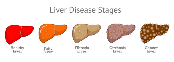 香港逾百萬人患脂肪肝！醫生警告做錯1步恐變肝癌  每日食1款平民食物12週極速降肝炎指數