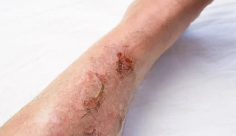 20cm巨型蜈蚣殺入屋！被咬千祈咪用火酒消毒？專家揭急救謬誤：亂搽恐致傷口潰爛