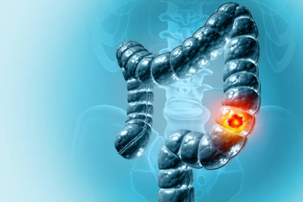 12歲童肚痛竟患末期大腸癌！醫生嘆吃3物當正餐出事／誤為腸胃炎延誤醫治