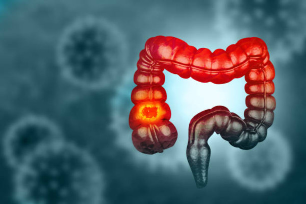 12歲童肚痛竟患末期大腸癌！醫生嘆吃3物當正餐出事／誤為腸胃炎延誤醫治
