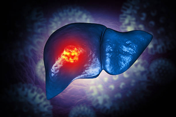 男子無痛楚僅肚瀉3個月驚揭末期肝癌！醫生嘆：肝臟已密密麻麻塞滿 揭1致命病史