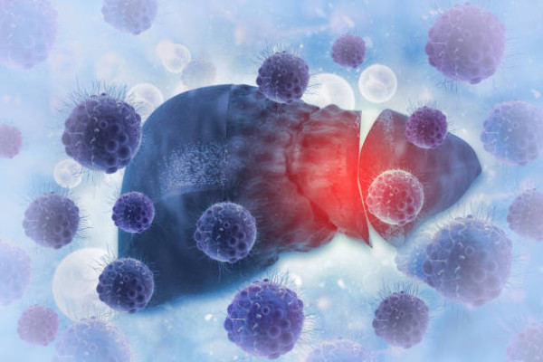 男子無痛楚僅肚瀉3個月驚揭末期肝癌！醫生嘆：肝臟已密密麻麻塞滿 揭1致命病史