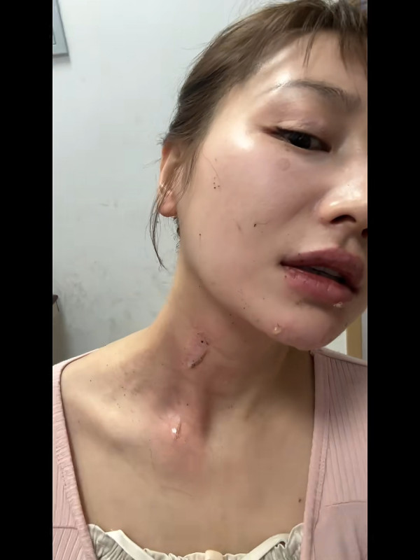 26歲女藝人跟風玩噴火蛋糕慘遭烈焰焚面！96度酒精回火險毀容 怒轟網紅濾鏡害人