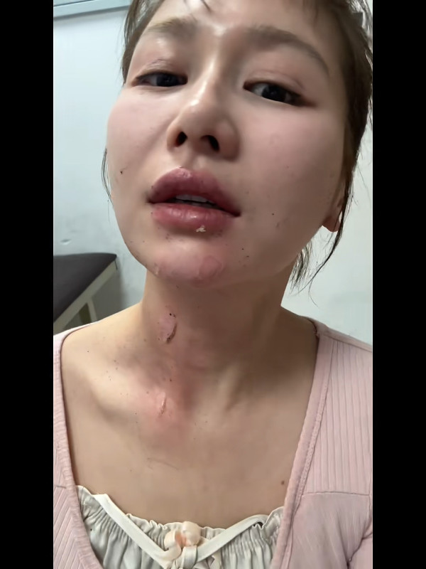 26歲女藝人跟風玩噴火蛋糕慘遭烈焰焚面！96度酒精回火險毀容 怒轟網紅濾鏡害人