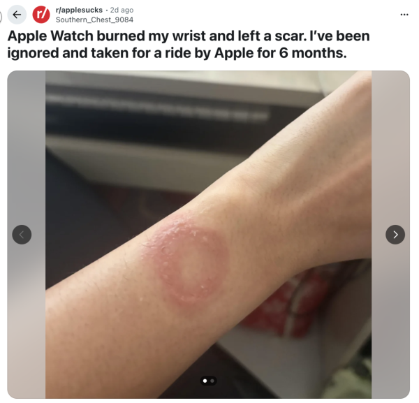 戴智能手錶訓覺好危險？Apple Watch 驚現灼傷手腕 維權半年官方竟然咁處理？【附 5 招睡眠安全佩戴貼士】