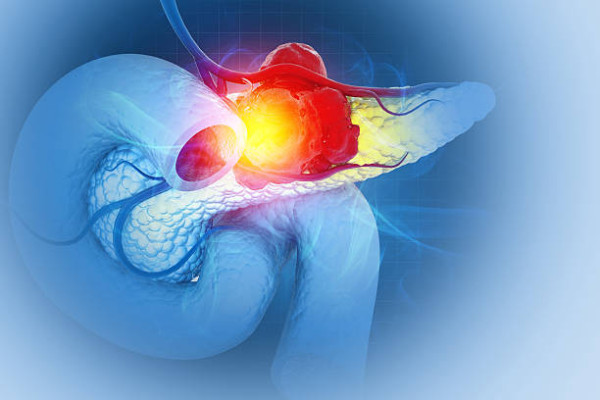 60歲婦末期胰臟癌剩3個月命！中醫授1款抗癌丁丁湯+2習慣 7年零復發