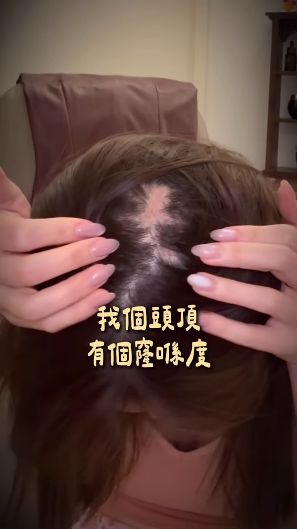 五索驚爆嚴重鬼剃頭一直戴假髮！頭頂禿大塊慘況嚇窒網民︰成個頭都甩晒