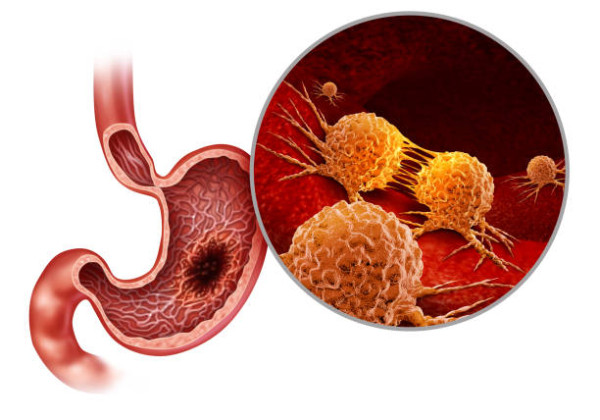 以為熱氣淋巴腫？20歲女頸痛起包驚揭沉默殺手末期/醫生警告小心1個食飯習慣