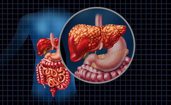 以為食湯麵好清淡？30歲IT男狂食「1偽健康食物」 醫生警告：肝功能超標5倍！
