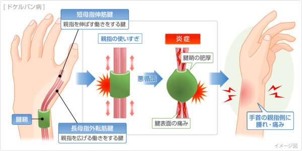 手痛晚期可致永久功能喪失？ 一文睇清「手機手」同「滑鼠手」教你3秒極速自查【附 5 分鐘恢復運動】