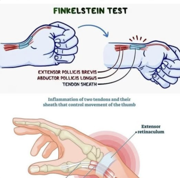 手痛晚期可致永久功能喪失？ 一文睇清「手機手」同「滑鼠手」教你3秒極速自查【附 5 分鐘恢復運動】