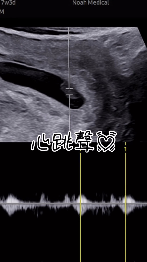 31歲前港姐宣佈懷孕驚曝流產跡象 心情跌落谷底：發現出血的那一刻