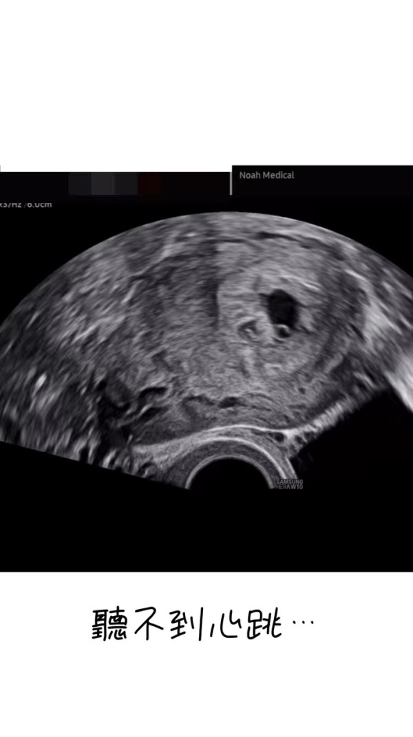 31歲前港姐宣佈懷孕驚曝流產跡象 心情跌落谷底：發現出血的那一刻