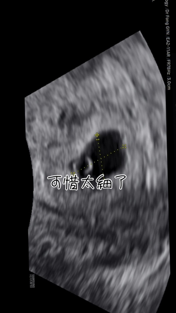 31歲前港姐宣佈懷孕驚曝流產跡象 心情跌落谷底：發現出血的那一刻