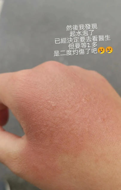 擠檸檬起巨型水泡險毀容！揭恐怖化學灼傷真相 24小時後噩夢開始