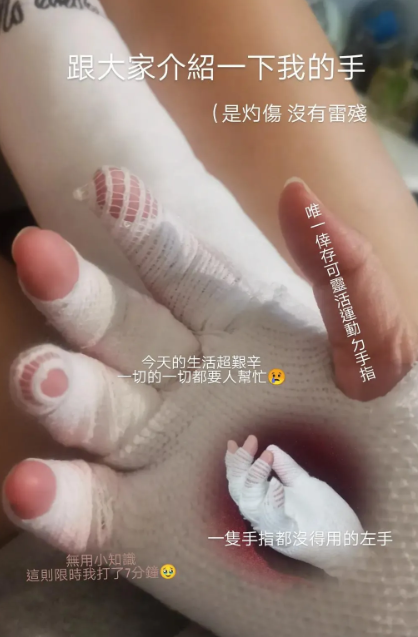 擠檸檬起巨型水泡險毀容！揭恐怖化學灼傷真相 24小時後噩夢開始