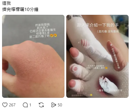 擠檸檬起巨型水泡險毀容！揭恐怖化學灼傷真相 24小時後噩夢開始