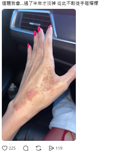 擠檸檬起巨型水泡險毀容！揭恐怖化學灼傷真相 24小時後噩夢開始