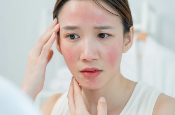 擠檸檬起巨型水泡險毀容！揭恐怖化學灼傷真相 24小時後噩夢開始