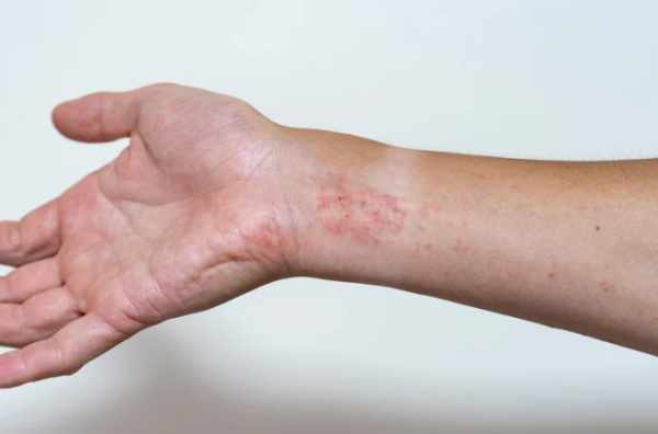 擠檸檬起巨型水泡險毀容！揭恐怖化學灼傷真相 24小時後噩夢開始