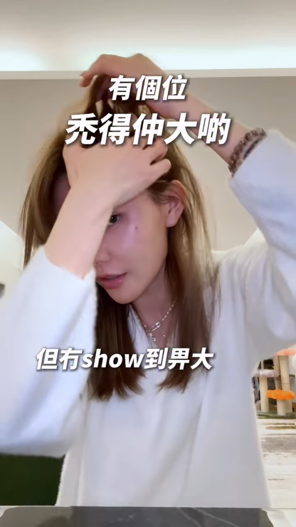 五索承認鬼剃頭「禿到唔會再有反應」情況惡化兩側寸草不生畫面觸目驚心