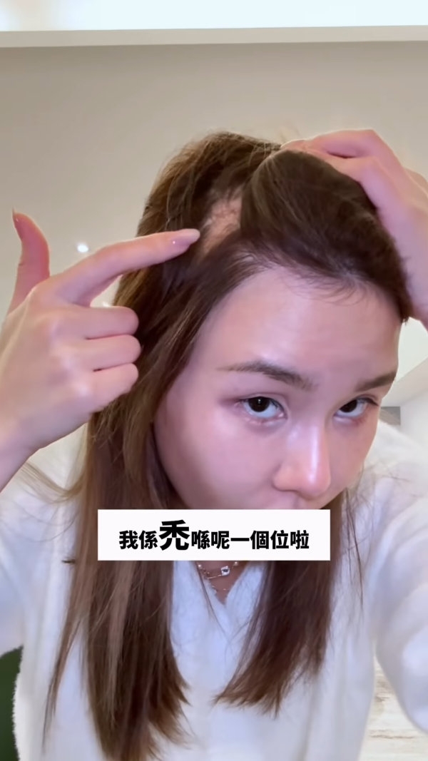 五索承認鬼剃頭「禿到唔會再有反應」情況惡化兩側寸草不生畫面觸目驚心