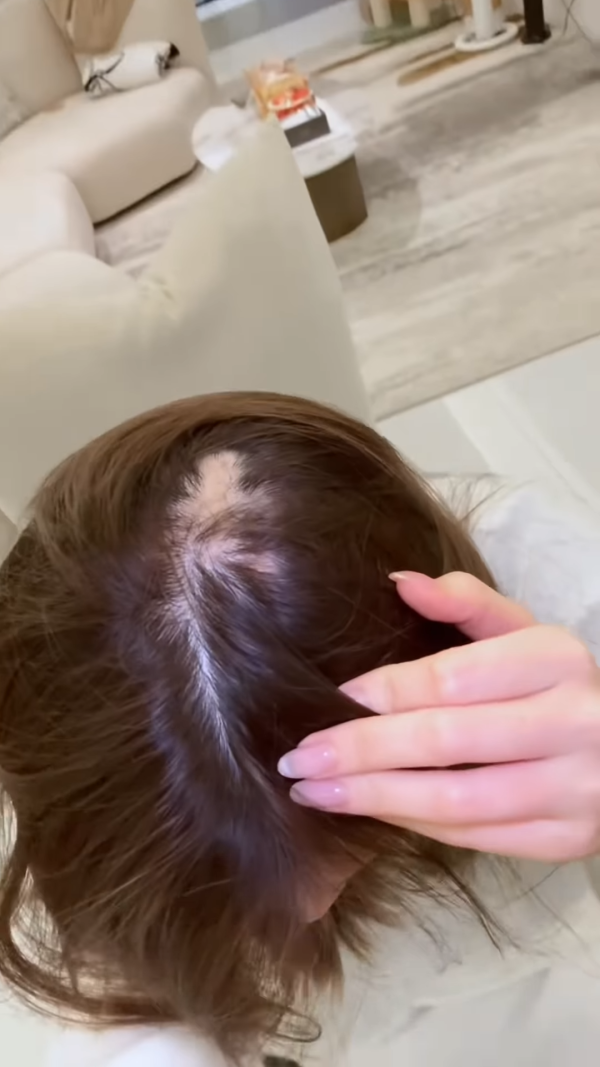 五索承認鬼剃頭「禿到唔會再有反應」情況惡化兩側寸草不生畫面觸目驚心