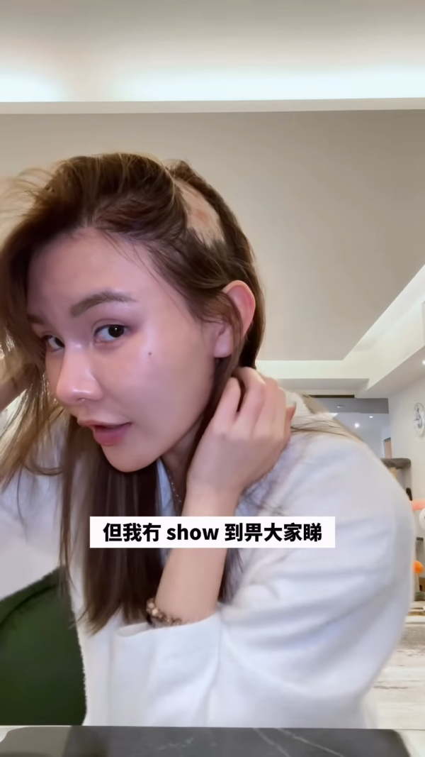 五索承認鬼剃頭「禿到唔會再有反應」情況惡化兩側寸草不生畫面觸目驚心