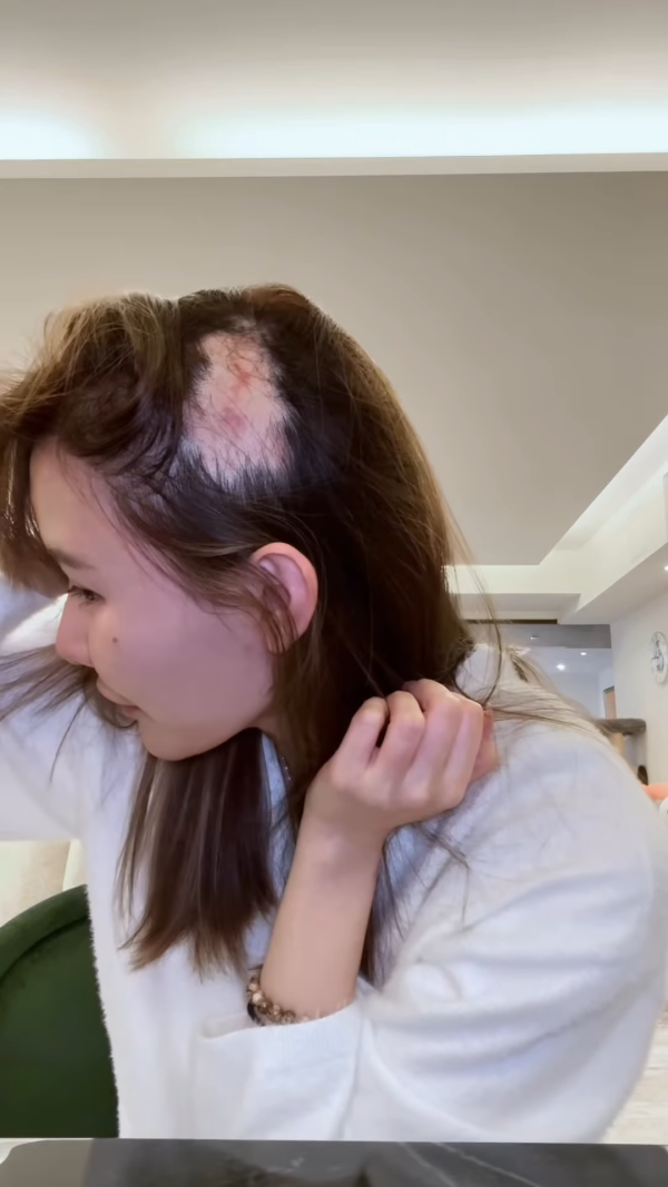 五索承認鬼剃頭「禿到唔會再有反應」情況惡化兩側寸草不生畫面觸目驚心