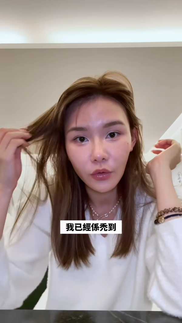 五索承認鬼剃頭「禿到唔會再有反應」情況惡化兩側寸草不生畫面觸目驚心