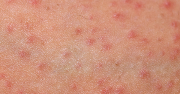 麻疹殺入香港機場！268人列密切接觸 病毒在空中可活2小時 可引發致命腦炎